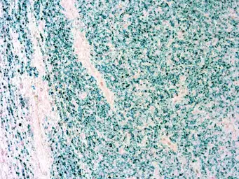 Anti-Melanoma antibody [PNL2] used in IHC (Paraffin sections) (IHC-P). GTX12502