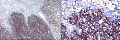 Anti-Carbonic Anhydrase IX antibody used in IHC (Paraffin sections) (IHC-P). GTX15086