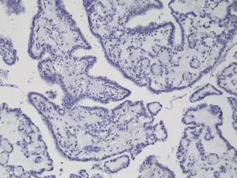 Anti-B-Raf (V600E Mutant Specific) antibody [RM8] used in IHC (Paraffin sections) (IHC-P). GTX33595