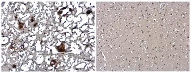 Human Matched Pair Tissue Array - Brain (Alzheimer's Disease + Normal). GTX49382