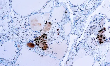 Anti-Calcitonin antibody (ready-to-use) used in IHC (Paraffin sections) (IHC-P). GTX73367