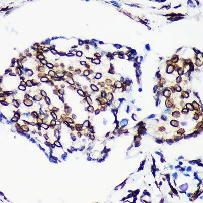 IHC-P analysis of hmuan breast cancer tissue section using GTX00774 Lamin A + C antibody [GT1137].<br>Dlution : 1:200