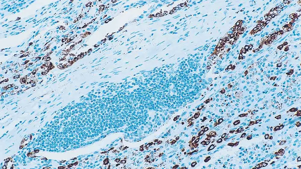 IHC-P analysis of human lung adenocarcinoma using GTX01854 Surfactant Protein A antibody [32E12]. Note intense cytoplasmic staining of type II pneumocytes and alveolar macrophages.