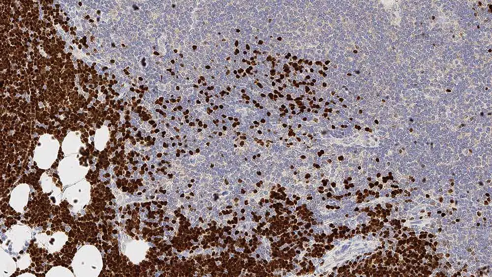 IHC-P analysis of human thymus tissue using GTX01873 TdT antibody [SEN28]. Note nuclear staining for cortical thymic lymphocytes.