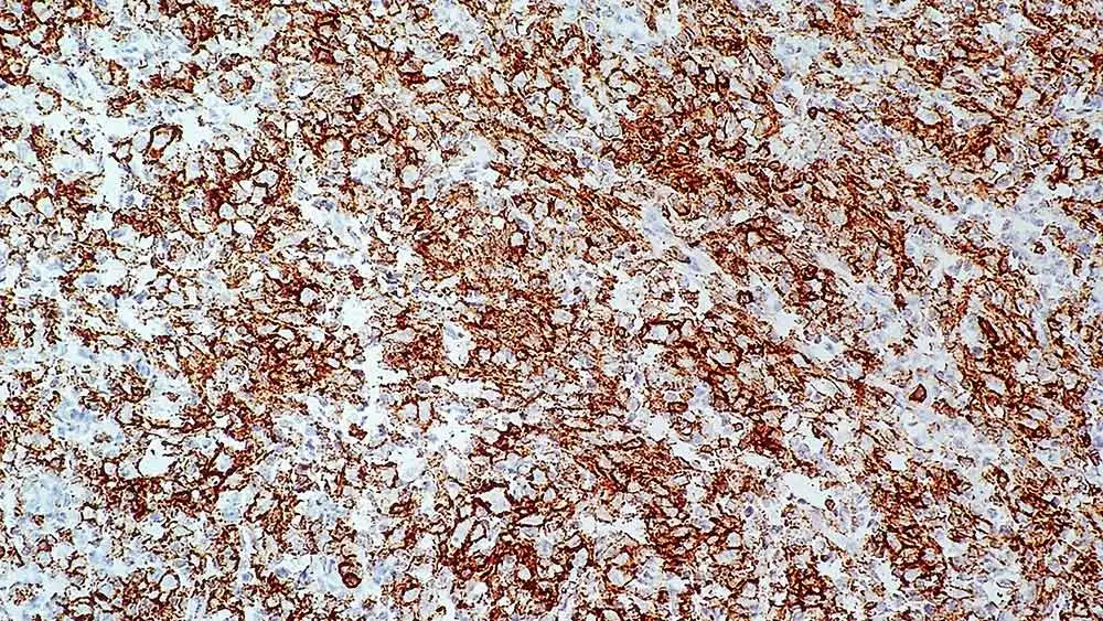 IHC-P analysis of diffuse large B cell lymphoma tissue using GTX01920 CD43 antibody [MT1]. Note the intense staining of malignant CD43: clone MT1