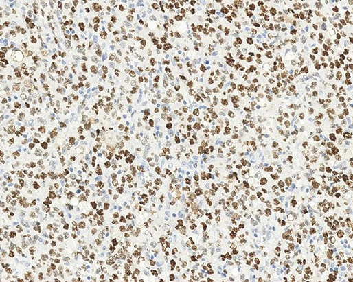 IHC-P analysis of human diffuse large B cell lymphoma using GTX01937 BCL6 antibody [LN22]. The majority of neoplastic cells show a moderate to strong nuclear staining reaction.
