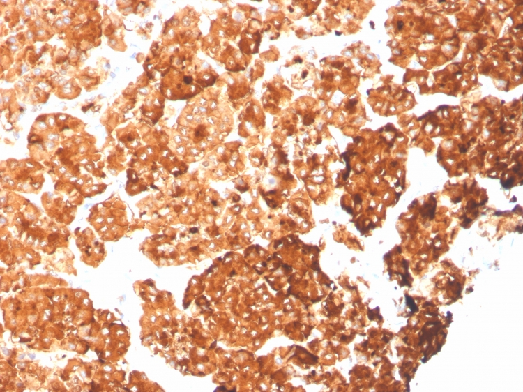 IHC-P analysis of human pancreas tissue section using GTX02661 Cytokeratin 6a antibody [rKRT6A/2100].