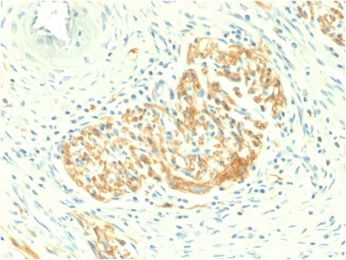 IHC-P analysis of human colon carcinoma section using GTX02686 NCAM antibody [NCAM1/2217R].