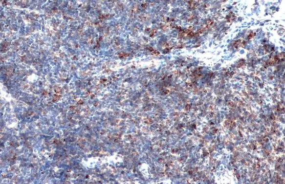 MMP9 antibody [N2C1],Internal detects MMP9 protein at cytosol on AGS xenograft by immunohistochemical analysis.