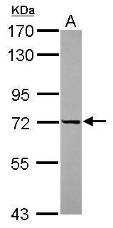 DDX43 antibody detects DDX43 protein at cytoplasm on human ovarian carcinoma by immunohistochemical analysis.Sample:Paraffin-embedded ovarian carcinoma.DDX43 antibody (GTX119498) dilution:1:500. Antigen Retrieval:Trilogy? (EDTA based,pH 8.0) buffer,15min