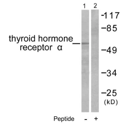 IHC-P analysis of human colon carcinoma tissue using GTX17590 Thyroid Hormone Receptor alpha antibody.