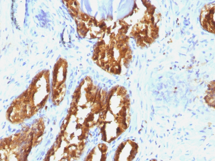 Formalin-fixed,paraffin-embedded human Prostate Carcinoma stained with PSAP Monoclonal Antibody (ACPP/1338).