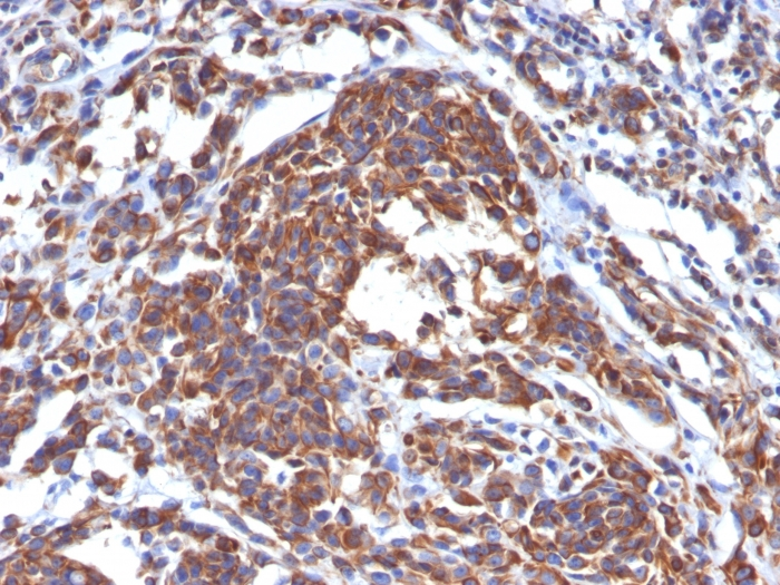 Formalin-fixed,paraffin-embedded human Melanoma stained with Vimentin Monoclonal Antibody (LN-6).
