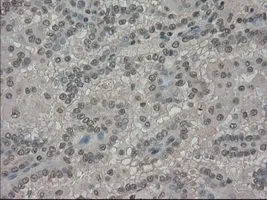 IHC-P analysis of kidney carcinoma tissue using GTX83620 SLC7A8 antibody [8B12]. Antigen retrieval : Heat-induced epitope retrieval by 10mM citrate buffer,pH6.0,100? for 10min. Dilution : 1:50