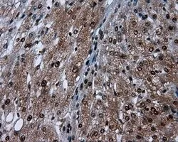 IHC-P analysis of human ovary adenocarcinoma tissue using GTX83645 SIL1 antibody [1F9]. Antigen retrieval : Heat-induced epitope retrieval by 10mM citrate buffer,pH6.0,100? for 10min. Dilution : 1:50