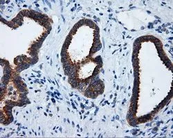 IHC-P analysis of prostate carcinoma tissue using GTX83734 RALBP1 antibody [2A6]. Antigen retrieval : Heat-induced epitope retrieval by 10mM citrate buffer,pH6.0,100? for 10min. Dilution : 1:50