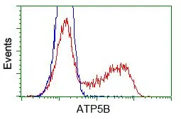 IHC-P analysis of liver carcinoma tissue using GTX84841 ATP5B antibody [5G2]. Antigen retrieval : Heat-induced epitope retrieval by 10mM citrate buffer,pH6.0,100? for 10min. Dilution : 1:50