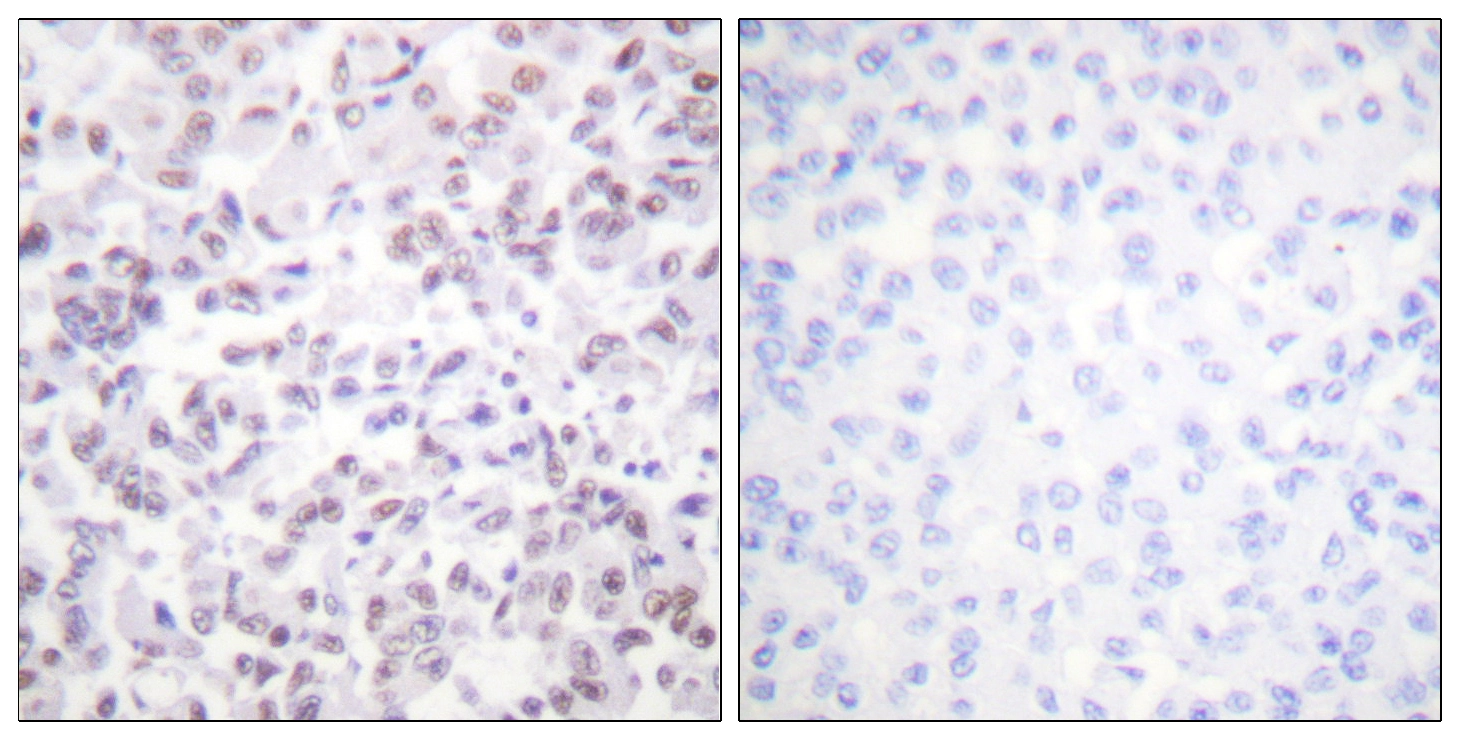 IHC-P analysis of human breast carcinoma tissue using GTX87385 Histone H2B antibody. The picture on the right is blocked with the synthesized peptide.